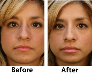 lip fillers before and after the procedure