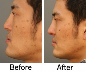 asian rhinoplasty results on a patient in charlotte nc