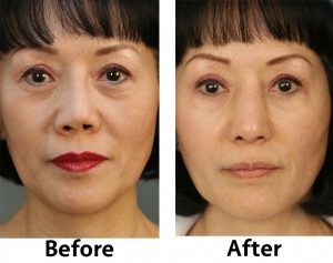 revision rhinoplasty on an asian patient from charlotte nc