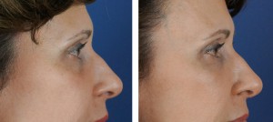 Kulbersh Cannula Eyelift eyelift results in north carolina