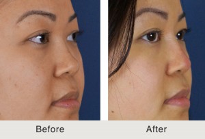 before and after image of a patient with non surgical rhinoplasty