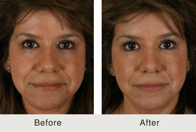 Reduce swelling brusing facial surgery