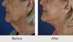 Facelift Surgery Charlotte