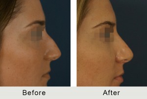 teenage rhinoplasty before and after the procedure