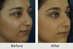 middle eastern nose job before and after