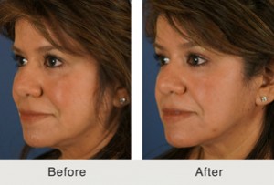 liquid eyelift to reverse aging