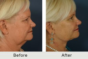 revision facelift before and after