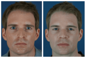nose job before and after results in Charlotte, NC