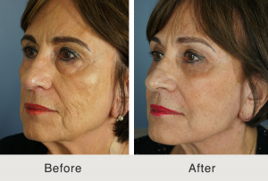 deep plane facelift results