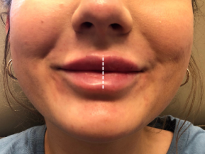 lip augmentation with fillers 