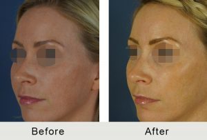 liquid nose job before and after