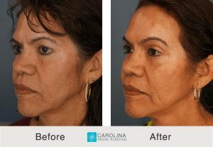 deep plane facelift on a latina patient