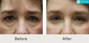 lower eyelid surgery before and after