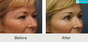 upper blepharoplasty before and after