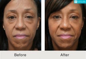 Lower Blepharoplasty results in Charlotte, NC