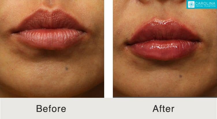 lip filler before and after