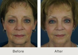 paciente de estiramiento facial en charlotte nc