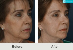 facelift facial rejuvenation results in Charlotte, NC