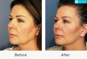 mini facelift for face rejuvenation