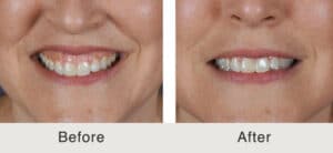Botox to treat gummy smile results in Charlotte, NC