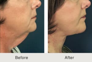 before and after results from a facelift and neck lift combination procedure in Charlotte, NC