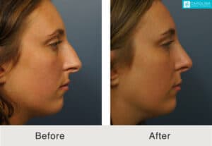 rinoplastia antes y despues en charlotte nc