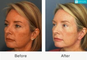 mini facelift results on a female patient