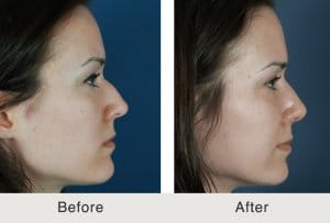 Two side-shots of a woman comparing the results before and after rhinoplasty to remove hump. The nose has no hump in the after side-shot, Charlotte, NC.