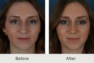 Before and after images of a young woman with rhinoplasty for lump removal in Charlotte, NC.