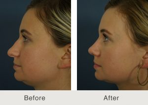 Two sideshots of a young woman with a hump on the nose, which is removed in the second image after rhinoplasty procedure for hump removal in Charlotte, NC.