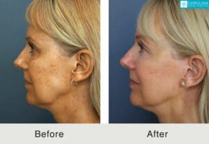 mini facelift before and after results on a female patient