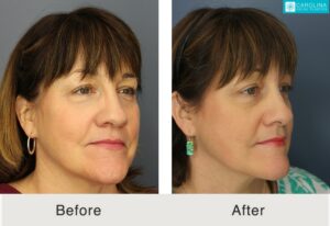 before and after results from a ProfoundRF treatment in Charlotte, NC