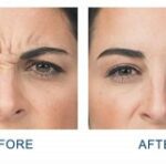 non-surgical facelift before and after results in Charlotte, NC