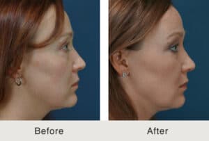 non-surgical facelift before and after results in Charlotte