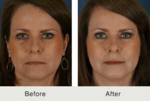 Cheek Augmentation Voluma Juvederm Voluma before and after results in Charlotte, NC