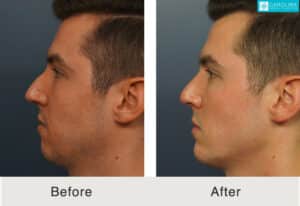 Rinoplastia antes y después de los resultados en Charlotte, NC