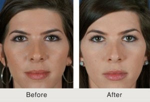 Nonsurgical Browlift