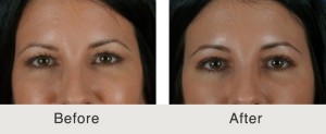 Upper Blepharoplasty before and after