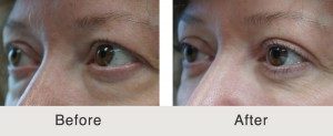 Blepharoplasty Surgery Cost charlotte