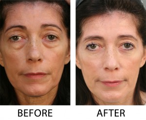 Lower Blepharoplasty