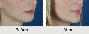 Rhinoplasty With Chin Implant in Charlotte 