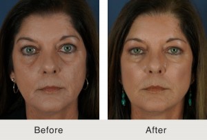 Kulbersh-líquido-estiramiento facial2-grande-4-10-14