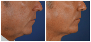 Liquid necklift before and after in Charlotte, NC