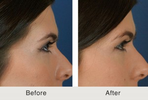 Kulbersh-NonSurgicalBrowlift3-large