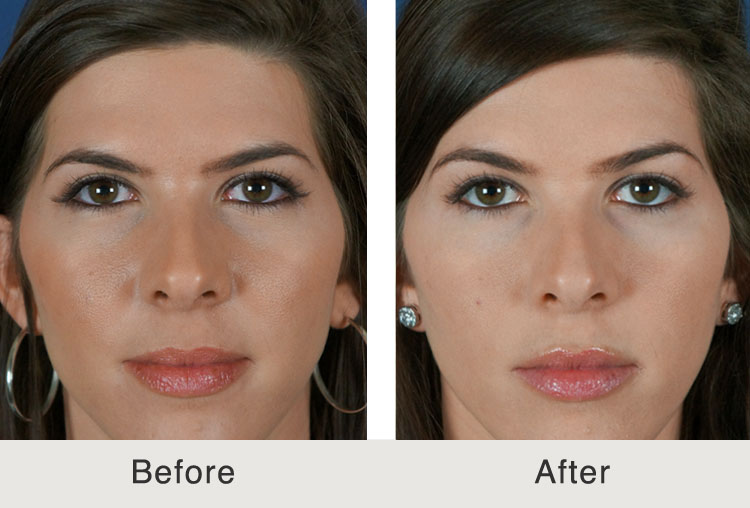 What Is A Non-Surgical Browlift? | Carolina Facial Plastics