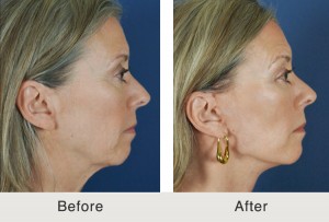 Mini lift and dermal fillers in Charlotte