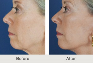 Mini lift and dermal fillers in Charlotte