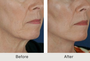 Mini lift and dermal fillers in Charlotte