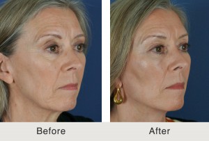 Mini lift and dermal fillers in Charlotte