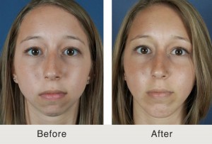 Chin Augmentation Before & After Gallery - DrKolstad - San Diego Facial  Plastic Surgeon